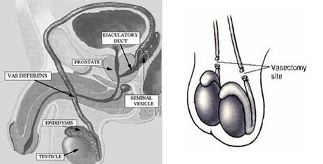 What is a Vasectomy?