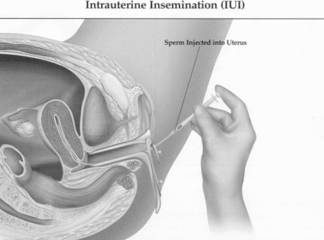 Intrauterine Insemination (IUI)