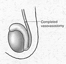 Completed Vasectomy