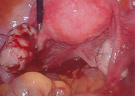 Endometriosis of the left ovary